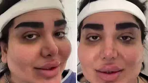 Yüzüne estetik yaptırdı ama boşa gitti: Değişimi görenler şaşkınlığını gizleyemedi