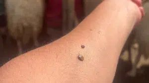Kene alarmı verildi: Uzmanlardan hayati uyarılar