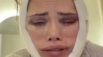 Didem Ceran estetik sonrası isyan etti! Son hâli gündem oldu