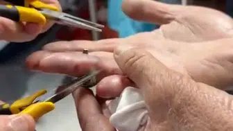 Batman'da yaşlı adamın parmağına sıkışan yüzük hastanede çıkarıldı