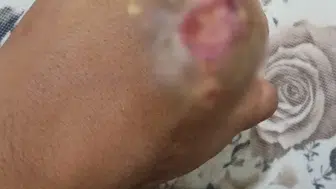 Kilis'te iş kazasında 5 parmağını kaybeden Mustafa Gez, 8 aydır iş arıyor