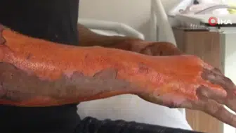 'Bomba gibi patladı, kendimi zor attım': Arabasının aküsü öyle bir patladı ki vücudunun yüzde 25'i yandı