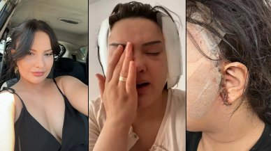 'Badem göz' ameliyatı hayatını kararttı