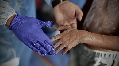 Uzmanından "Uyuz vakaları her geçen gün artıyor" uyarısı