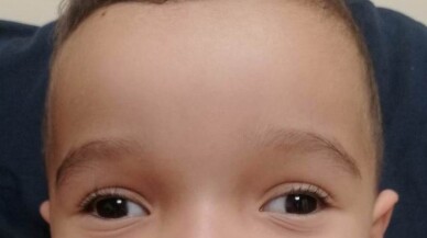 Şaşılığı olan her bebeğin mutlaka göz doktoruna götürülmesi gerekir