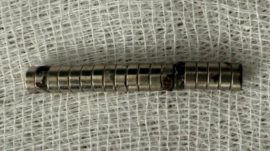 Doktorlar şaştı: Küçük çocuğun boğazından 19 mıknatıs çıkarıldı!