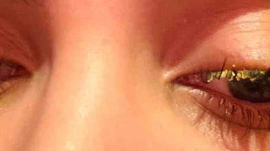 Esenyurt'ta güzellik merkezi faciası: Kirpik yaptırayım derken kör oluyordu!