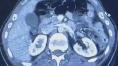 Uyuşturucuyu mideye sakladılar, Kayseri’de yakalandılar!