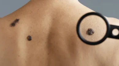 Sessiz Tehlike: Melanom Cilt Kanseri Sizi Fark Etmeden Öldürebilir! Melanom Nedir, Büyüme Hızı Ne Kadardır, Ağrı Yapar mı, Belirtileri Nelerdir?
