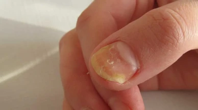 Ayak Sağlığınızı Tehdit Eden Tırnak Mantarı! Tedavisi ve Önleme Yöntemleri