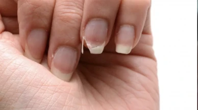 Tırnak Bozulmaları ve Hastalık Belirtileri: Dikkat Edilmesi Gerekenler