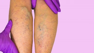 Yürüyerek Hastaneden Çıkabilirsiniz! Ameliyatsız Varis Tedavisi