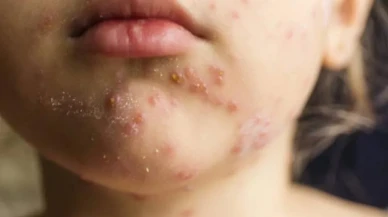 ABD’de Kızamık Salgını Büyüyor! Ölümler Başladı, Hastaneler Dolup Taştı!