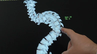 Skolyoz Sadece Sırtınızı Değil, Hayatınızı Etkileyebilir! Uzmandan Uyarı