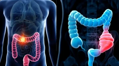 Gençlerde görülme sıklığı artan kolon kanserinde tarama yaşı düşüyor