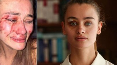 Ukraynalı model Daria Kyryliuk darp iddiasıyla ilgili konuştu