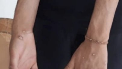 İstanbul'da maymun çiçeği şüphesi