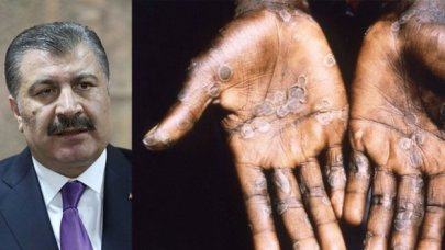 Beklenen felaket kapıyı çaldı: Türkiye'de ilk maymun çiçeği vakası