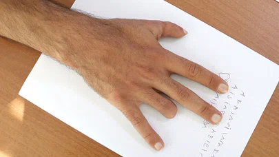 Konya'da yapılan 'parmak nakli' literatüre girdi