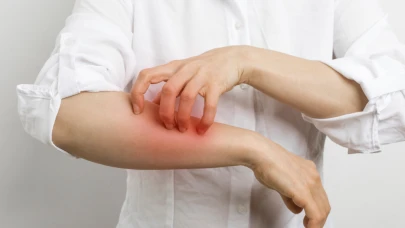 Artan kaşıntı ve kızarıklık varsa dikkat! Uyuz ilk nerede başlar? Uyuz en çabuk nasıl geçer?