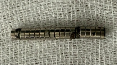 Doktorlar şaştı: Küçük çocuğun boğazından 19 mıknatıs çıkarıldı!