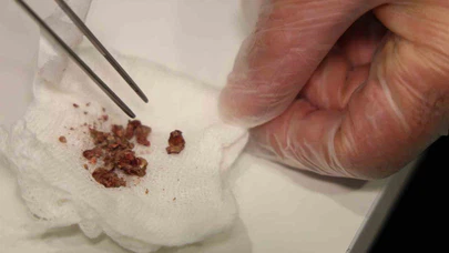 Estetik yaptıracağı burnundan taş çıktı: Elazığlı vatandaş yıllarca onunla yaşamış!