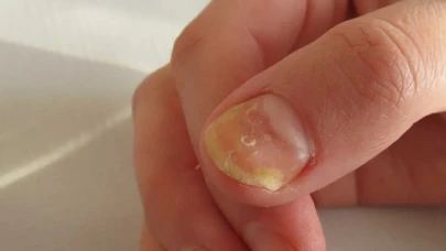 Ayak Sağlığınızı Tehdit Eden Tırnak Mantarı! Tedavisi ve Önleme Yöntemleri