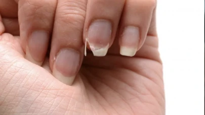 Tırnak Bozulmaları ve Hastalık Belirtileri: Dikkat Edilmesi Gerekenler