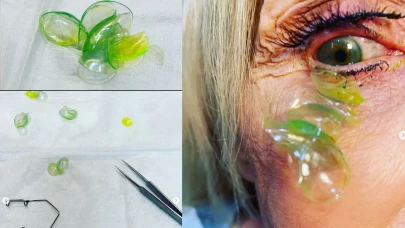 Kontakt Lens Kullanıyorsanız Dikkat! Bu Hata Felaketle Sonuçlanabilir!