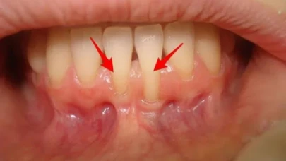 Diş Eti Çekilmesi Önlenebilir! Bu Adımları Takip Edin!