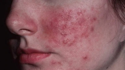 Gül Hastalığı (Rozasea) Nedir, Hangi Ciltlerde Sık Görülür, Belirtileri, Türleri, Tedavisi?