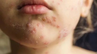 ABD’de Kızamık Salgını Büyüyor! Ölümler Başladı, Hastaneler Dolup Taştı!