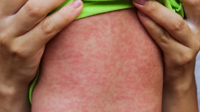 Avrupa ve Orta Asya’da Kızamık Vakaları Artıyor: Türkiye’de Durum Kontrol Altın mı?da