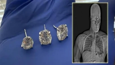 Akıllara Durgunluk Veren Soygun: Çaldığı Küpeleri Midesine Sakladı!