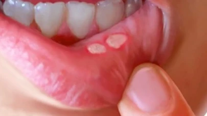 Ağzınızda Sürekli Aft mı Çıkıyor? Vücudunuzun Yardım Çığlığını Görmezden Gelmeyin!