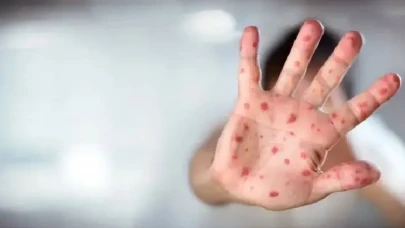 Salgın Kontrolden Çıkıyor: 624 Kızamık Vakası, Aşısızlar Alarmda!