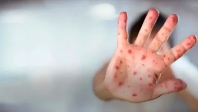 ABD’de Kızamık Vakaları 650’yi Aştı! Ölümler Artıyor