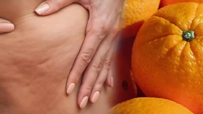 Selülit Gerçeği: Kadınları Neden Daha Çok Etkiliyor?