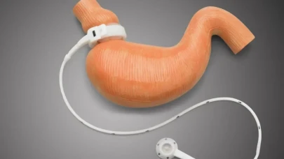 Mide Bandı Uygulamasıyla Obeziteyle Mücadelede Yeni Umut