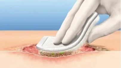 Debridman Nedir, Ameliyatı Nasıl Olur, Tedavi Yöntemleri Nelerdir?