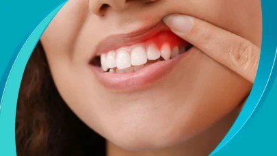 Diş Apsesi Hayati Tehlike Taşıyabilir!