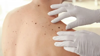 Benlerinizdeki değişiklikler tehlikeli mi? Uzmanlar sürekli gözlem yapmanızı öneriyor!