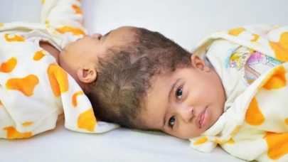 Dünya Nefesini Tuttu! Eritreli Siyam İkizleri Ayrıldı