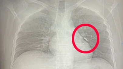 Diş tedavisinde vida akciğere saplandı, hayatı öksürükle kurtuldu