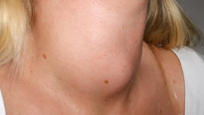 Boynundaki şişlik guatr habercisi olabilir