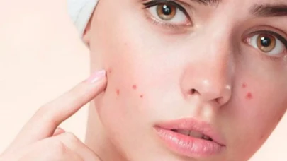 Akne: Nedenleri, türleri ve etkili çözüm yöntemleri