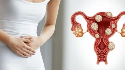 30 yaş sonrası her 3 kadından biri miyom sorunu ile karşılaşıyor: Ne yapmalı?