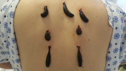 Doğa mucizesi mi, eski hurafe mi? Sülükler yeniden gündemde