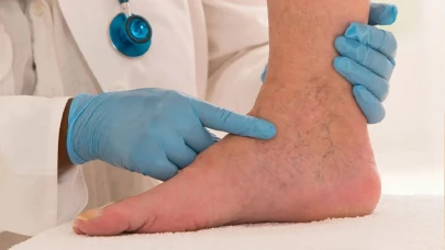 Bacak şişiyorsa dikkat: Hayati risk taşıyan hastalığın belirtisi olabilir