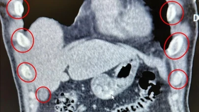 Midelerinden 136 kapsül uyuşturucu çıktı